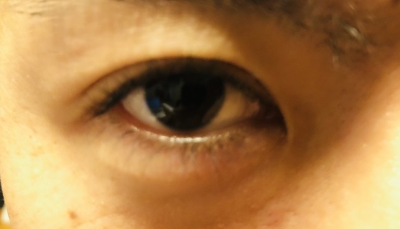 【緑内障】では眼圧が重要～眼科での診断、そして治療は？